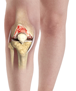 آرتروز زانو