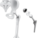 hip_replacement-min