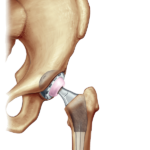 patients_hip-replacement_implant-illustration-min