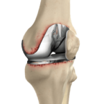revision-knee-replacement-min