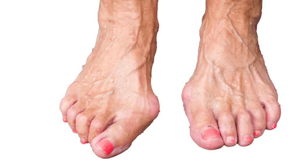 عمل دو طرفه هالگوس والگوس