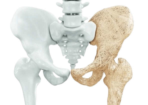 مرکز درمان پوکی استخوان در شمال تهران
