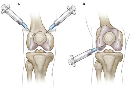 مرکز تزریق ژل زانو در شریعتی