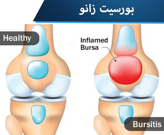 بورسیت زانو چیست
