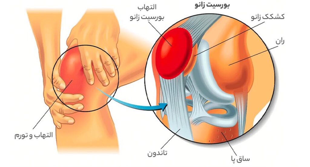 بهترین متخصص درمان بورسیت زانو