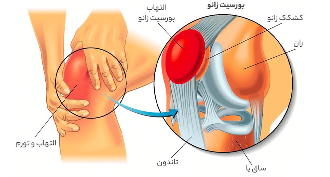 بورسیت زانو چیست؟