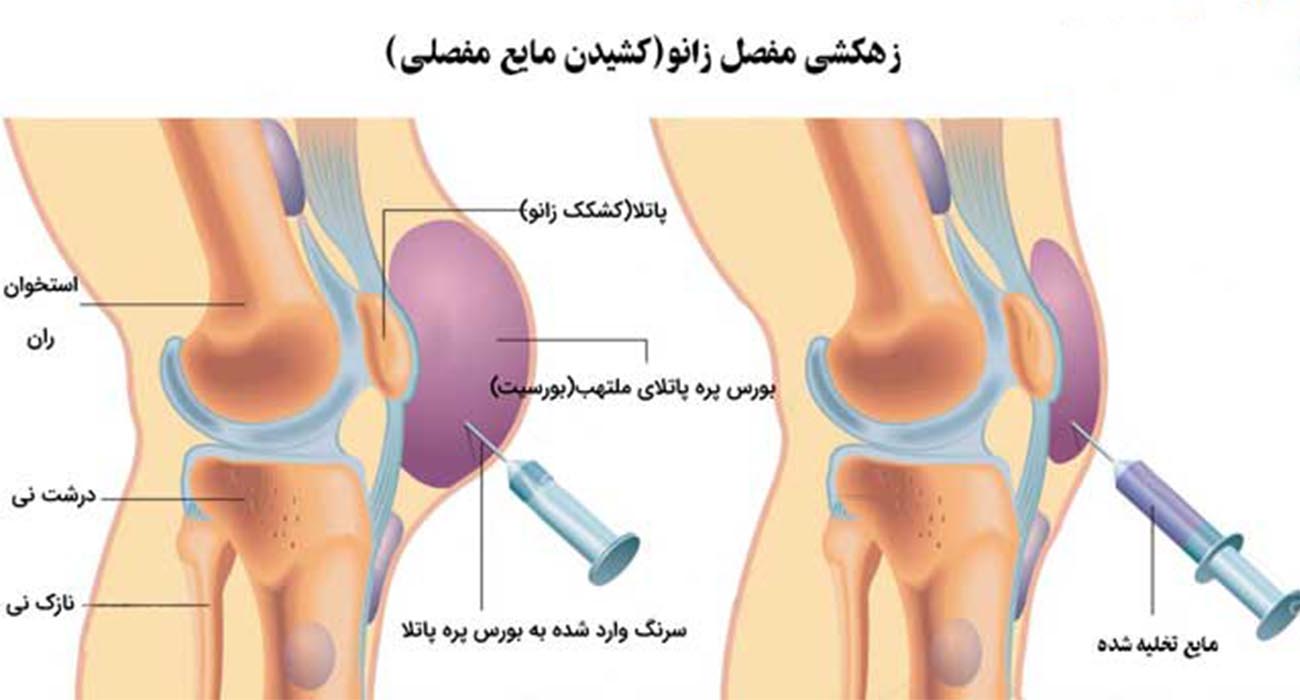 بورسیت زانو چیست؟