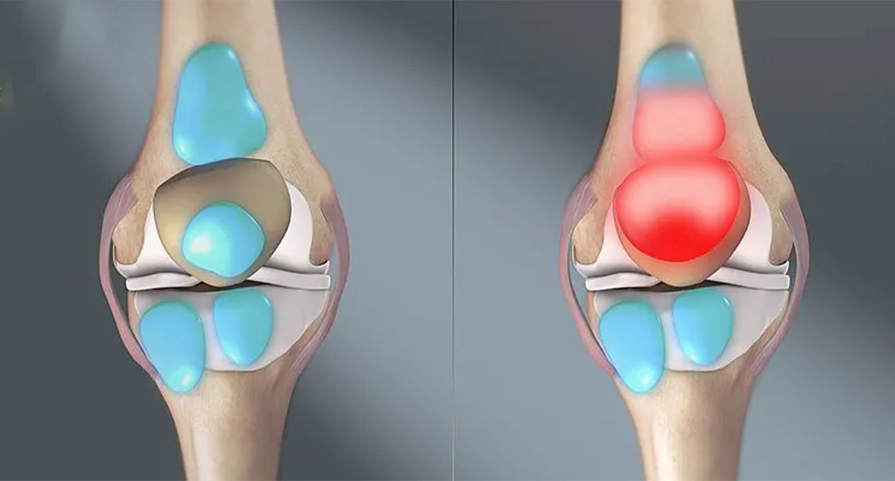 بورسیت زانو چیست؟