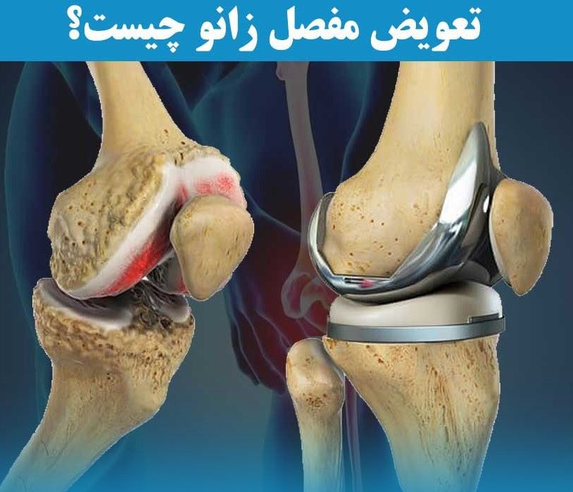 مرکز تعویض مفصل زانو