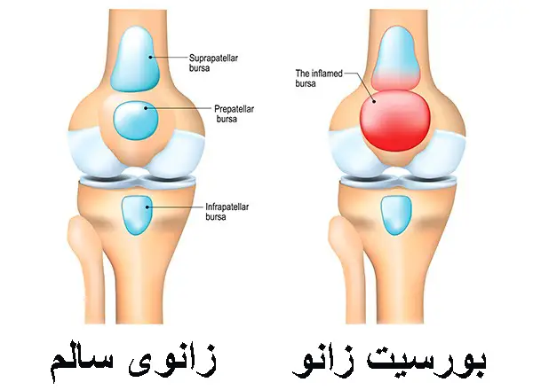 بهترین متخصص درمان بورسیت زانو