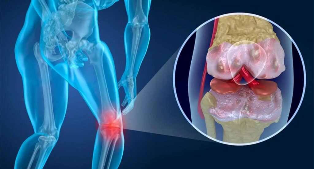 درمان آرتروز زانو