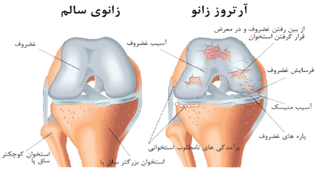 متخصص درمان آرتروز زانو جدیدترین روشها