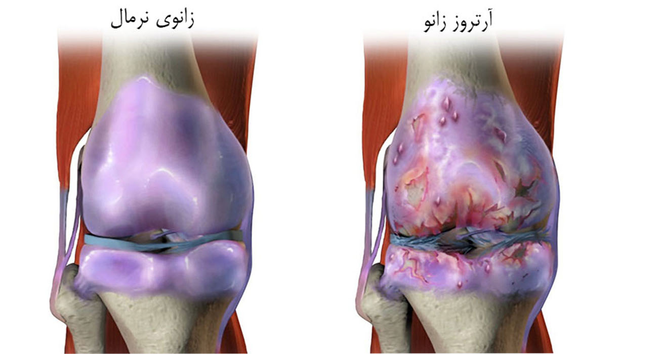مرکز درمان آرتروز زانو در شمال تهران