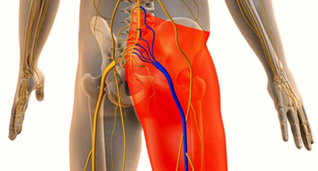 بهترین متخصص درمان سیاتیک