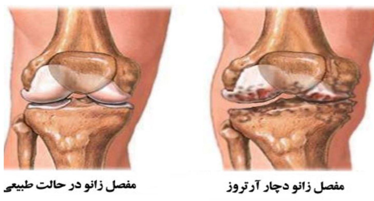 درمان آرتروز زانو