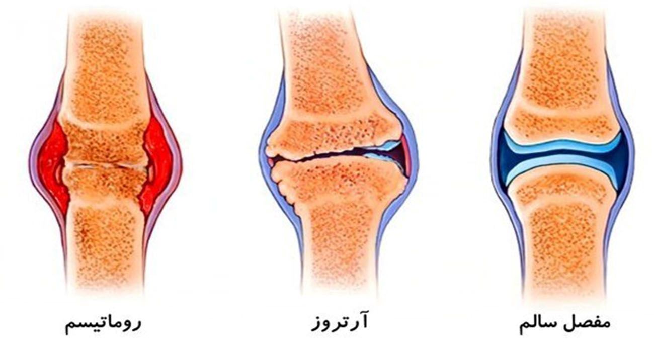 مرکز درمان آرتروز زانو در شمال تهران