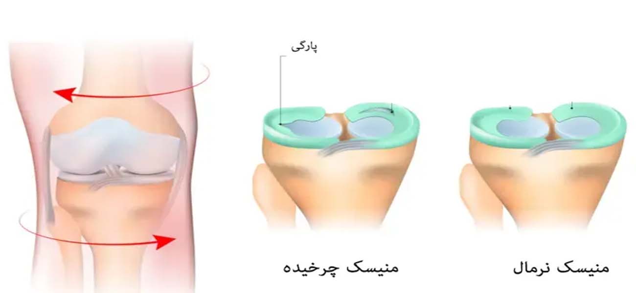 متخصص درمان پارگی مینیسک زانو