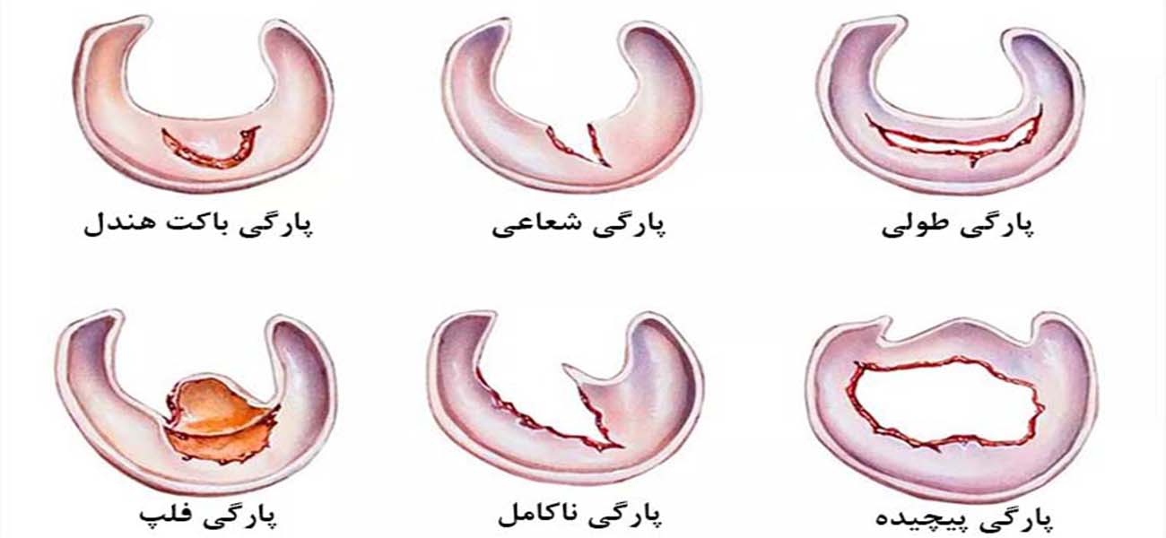 متخصص درمان پارگی مینیسک زانو
