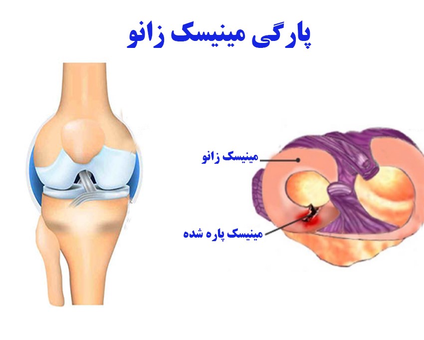 متخصص درمان پارگی مینیسک زانو