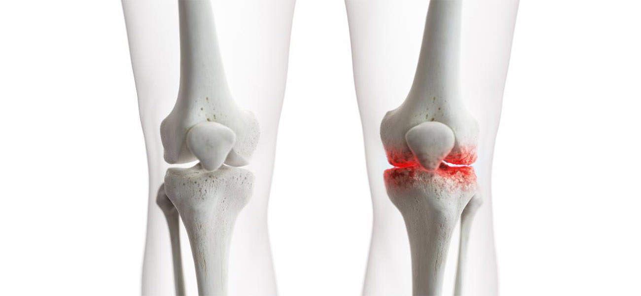 بهترین متخصص درمان آرتروز زانو