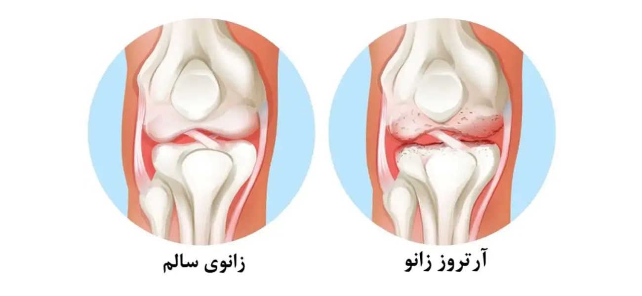 بهترین متخصص درمان آرتروز زانو