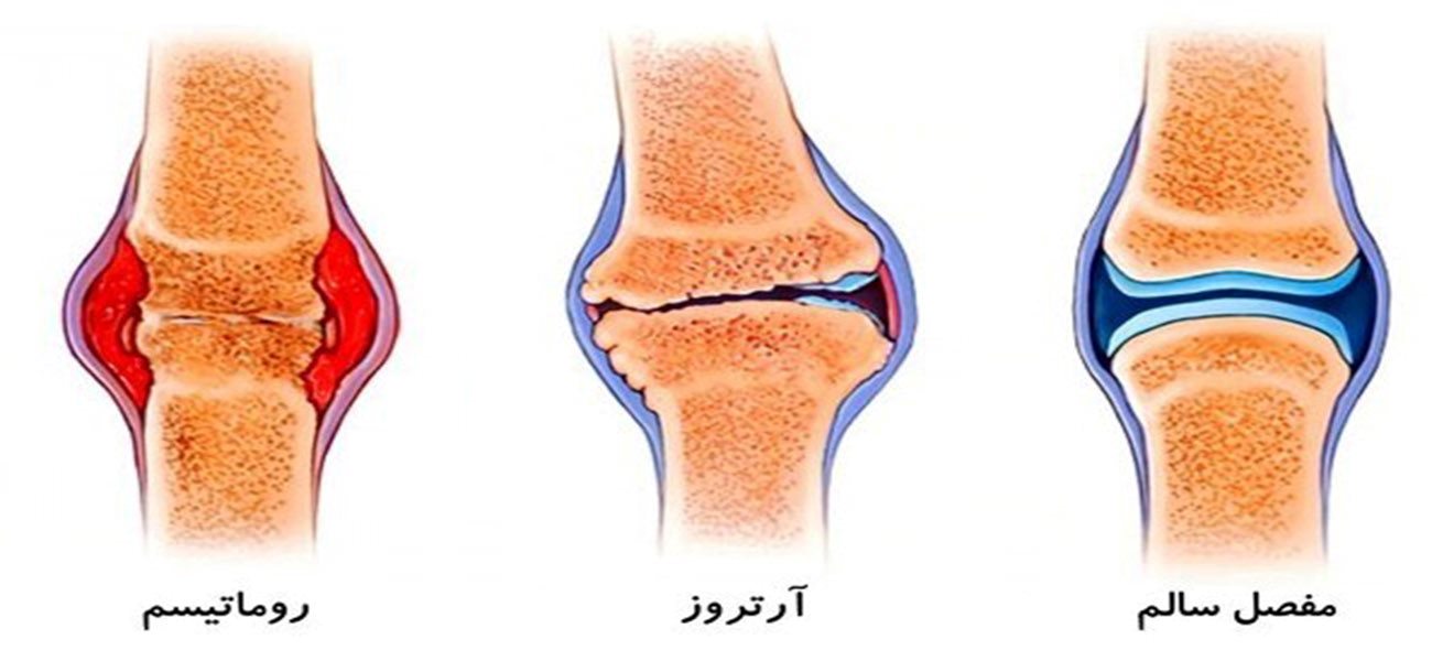 بهترین متخصص درمان آرتروز زانو