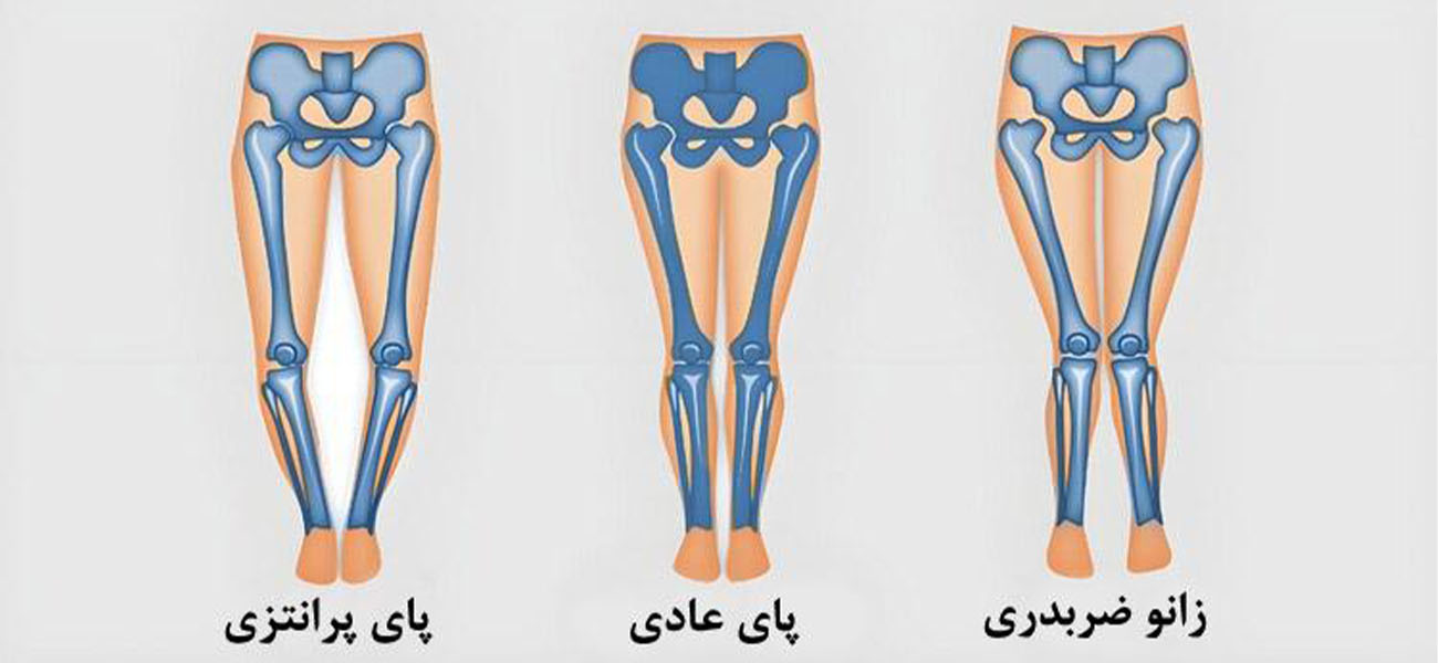 بهترین متخصص درمان زانوی پرانتزی
