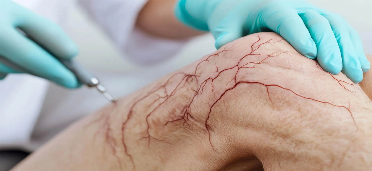 بهترین متخصص درمان واریس
