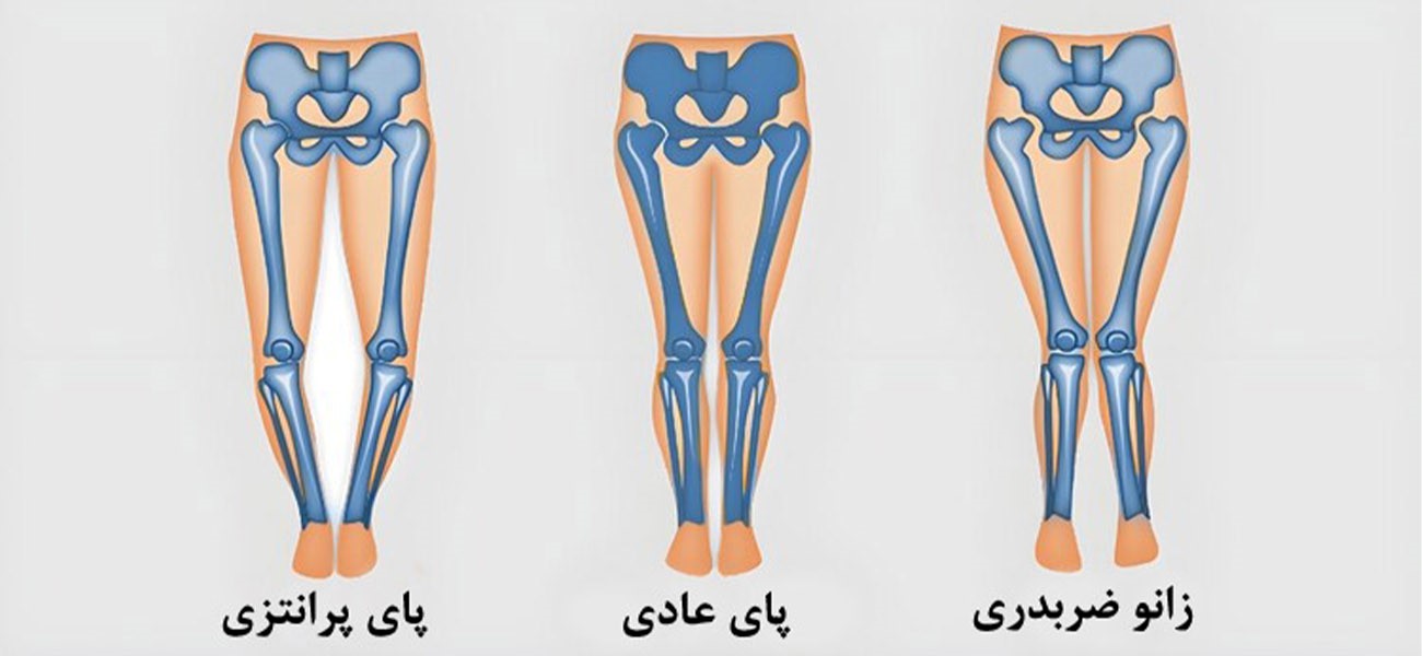 بهترین متخصص جراحی زانو ضربدری در تهران