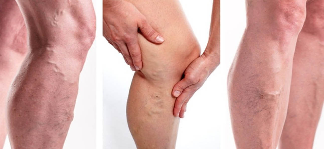 بهترین متخصص درمان واریس در تهران