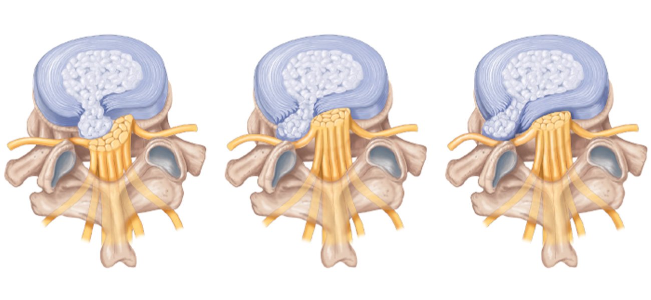 متخصص درمان غیر جراحی دیسک کمر